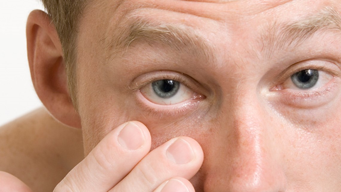 เยื่อบุตาอักเสบ